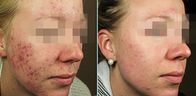 Red light therapy before and after